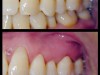 치경부 마모- 치아 목부분 패임 사례